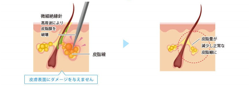 微細な針で治療するため皮膚表面にダメージを与えません。