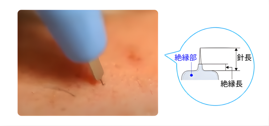微細な針は治療跡も残しません。