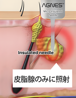 皮脂腺のみに高周波を与えるので火傷になりません。