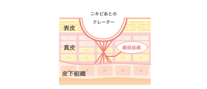 ニキビ跡のクレーターの仕組み