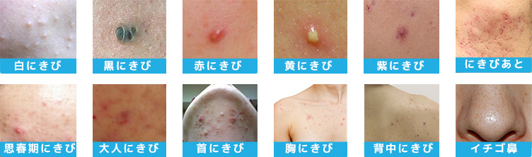 様々なニキビを治療することが可能です。