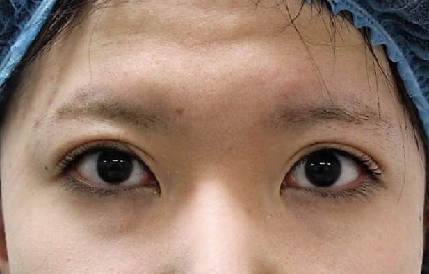 切らない眼瞼下垂治療後