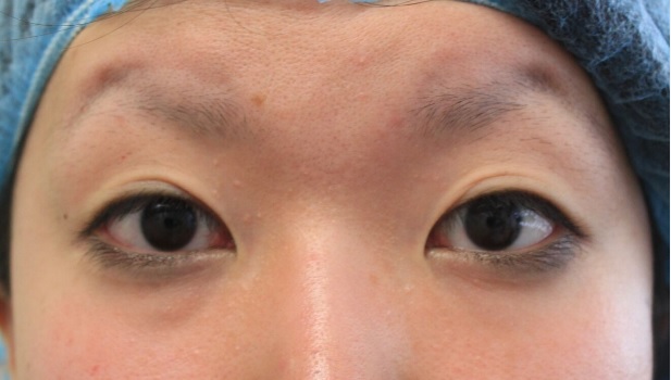 切らない眼瞼下垂治療前
