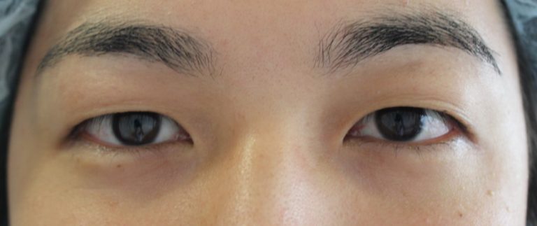 若い男の切らない眼瞼下垂治療前