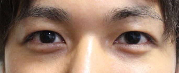 若い男の切らない眼瞼下垂治療後