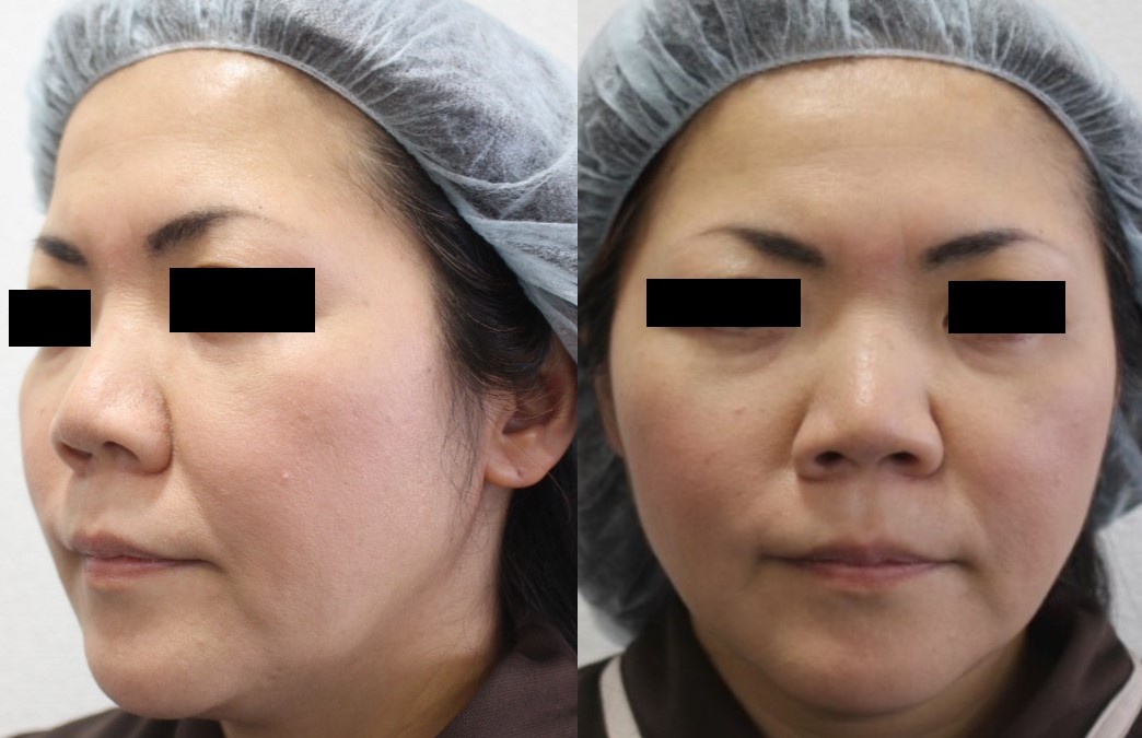 46歳女性 フェイスリフト手術の詳細経過 - 美容外科｜船橋中央