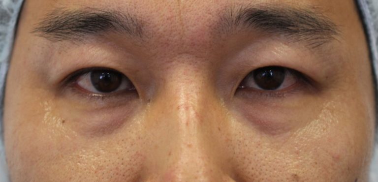 男の切らない眼瞼下垂後