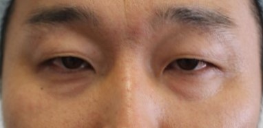 男性の切らない眼瞼下垂前