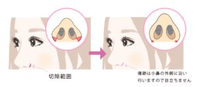 小鼻縮小外側切除法イラスト