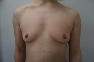 女性化乳房治療前