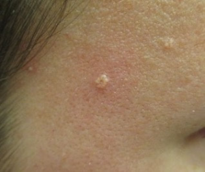 sebaceous hyperplasia