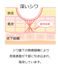 深いシワbefore