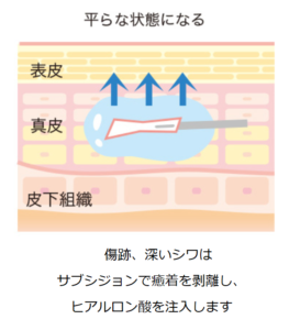 傷跡しわのサブシジョン