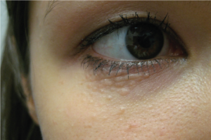 syringoma