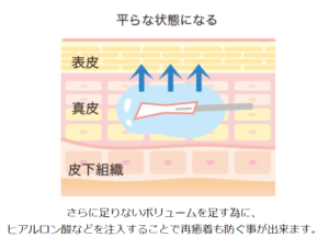 サブシジョンとヒアルロン酸組み合わせ