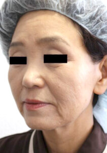 フェイスリフト手術前