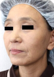 フェイスリフト手術後