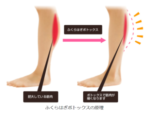 ふくらはぎボトックス注射