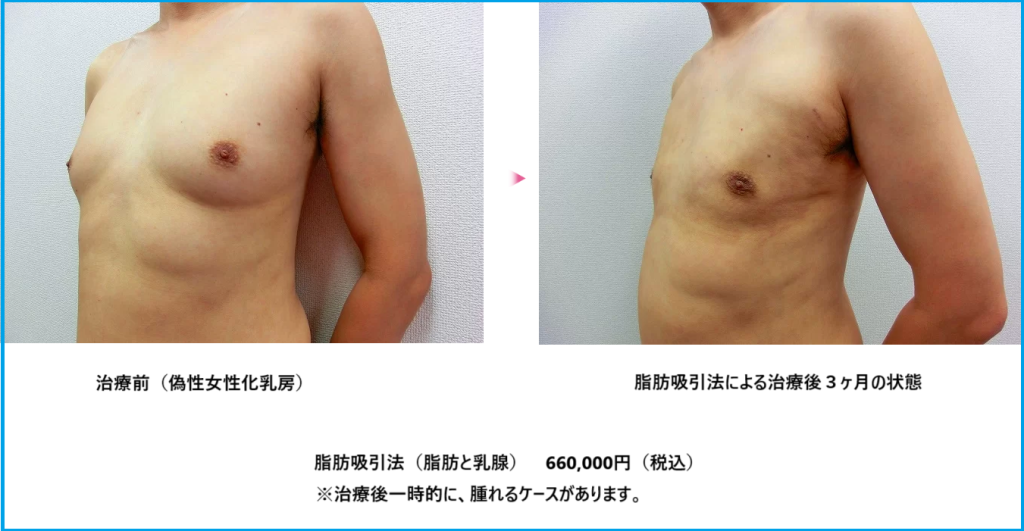 女性化乳房脂肪吸引