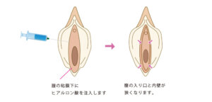 膣のヒアルロン酸注入