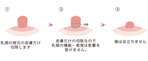 乳頭縮小手術高さ除去