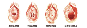 処女膜の形態