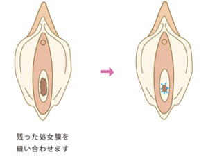 処女膜再生手術