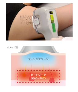 ミラドライの原理