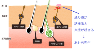 あせもができてしまうメカニズム