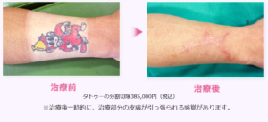 タトゥー切除の分割切除例の写真
