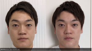 おばたのお兄さん整形前後