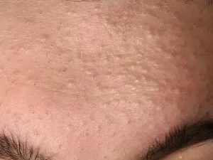 白ニキビ