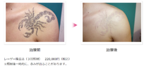 タトゥーのレーザー治療前後の写真