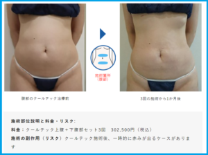 お腹のクールテック症例写真