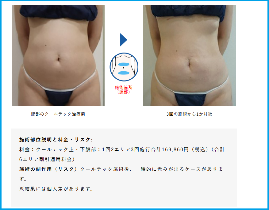↑脂肪冷却(クールテック)の治療前後写真