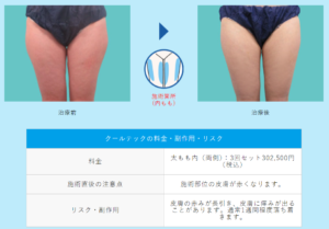 当院での太もものクールテック症例写真