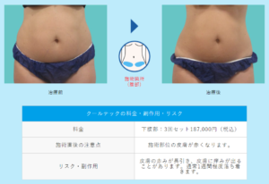 当院でのクールテック症例写真