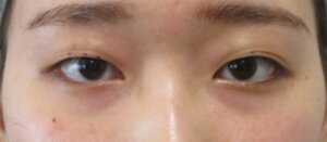 切らない眼瞼下垂治療治療前