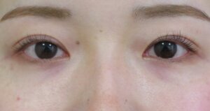 切らない眼瞼下垂治療治療後