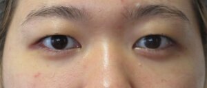 切らない眼瞼下垂治療治療前