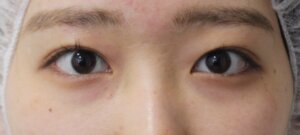 切らない眼瞼下垂治療治療後