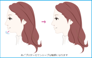 顎プロテーゼイラスト
