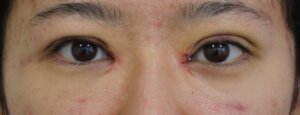 切らない眼瞼下垂治療アフター直後