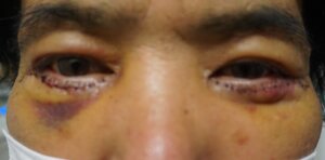 目の下のたるみ取り手術3日目