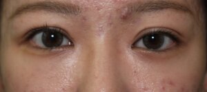 切らない眼瞼下垂治療アフター