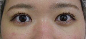 切らない眼瞼下垂治療治療後