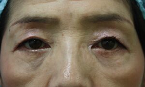 目の下のたるみ取り手術後3か月