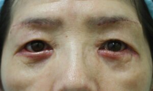 目の下のたるみ取り手術の抜糸時（7日目）