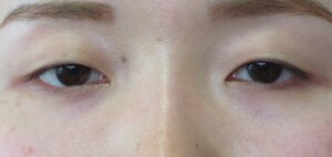 切らない眼瞼下垂治療治療前