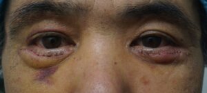 目の下のたるみ取り手術7日目